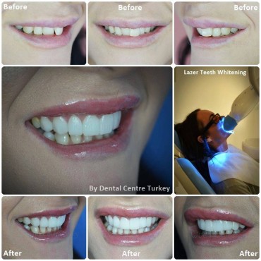 Dental Treatment in Fethiye