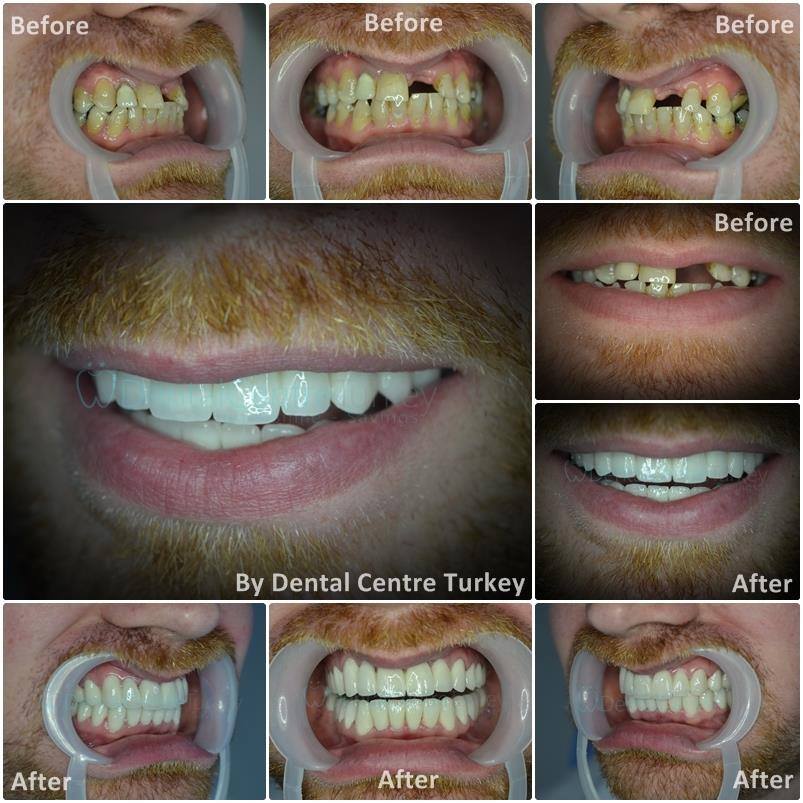before after gallery dentist fethiye