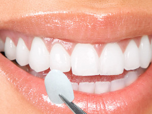 dental veneers fethiye
