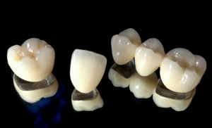 metal-porcelain-crowns-fethiye