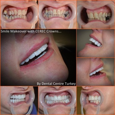 dentistry in fethiye